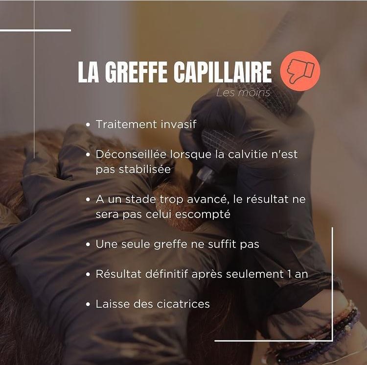 Tricopigmentation capillaire Tricopigmentation à Troyes Dotwork tattoo Dotwork Troyes